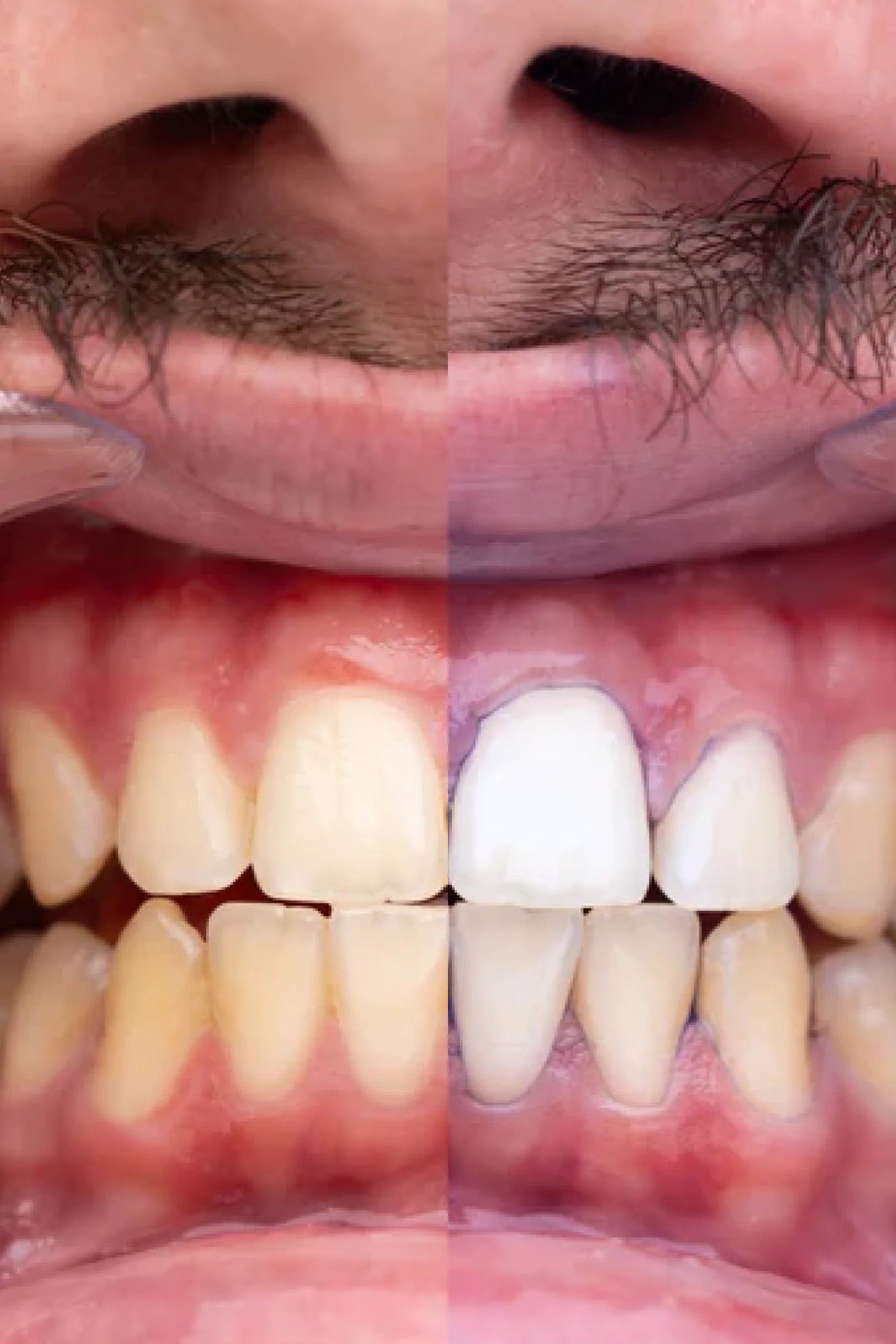 Teeth Whitening Gel - PURPLE V34