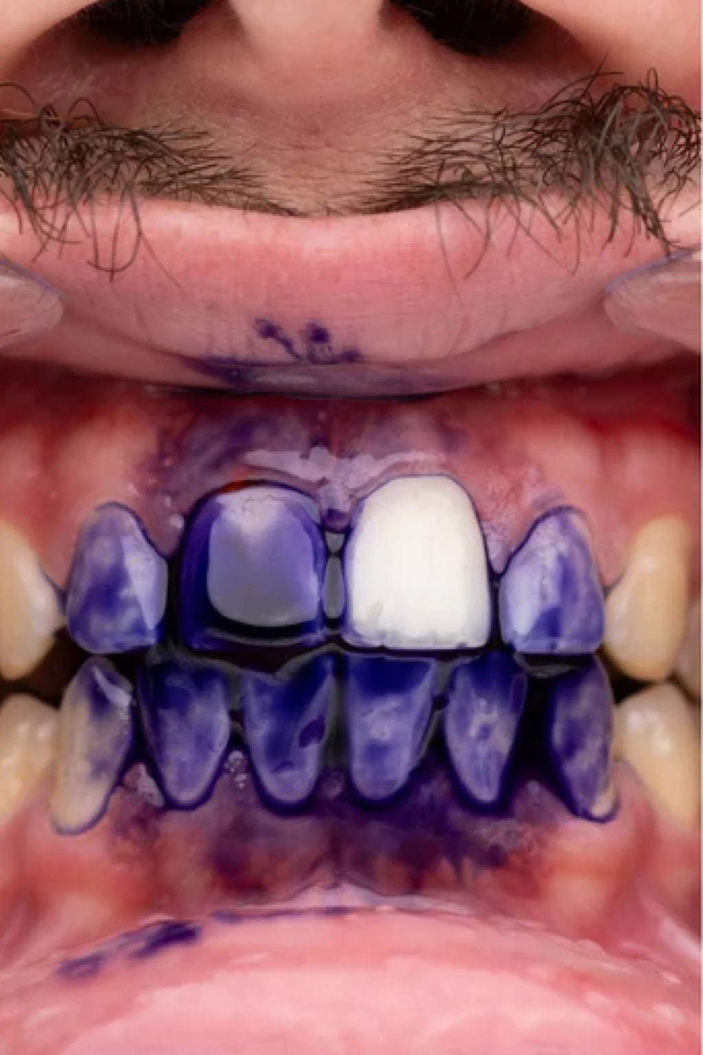 Teeth Whitening Gel - PURPLE V34